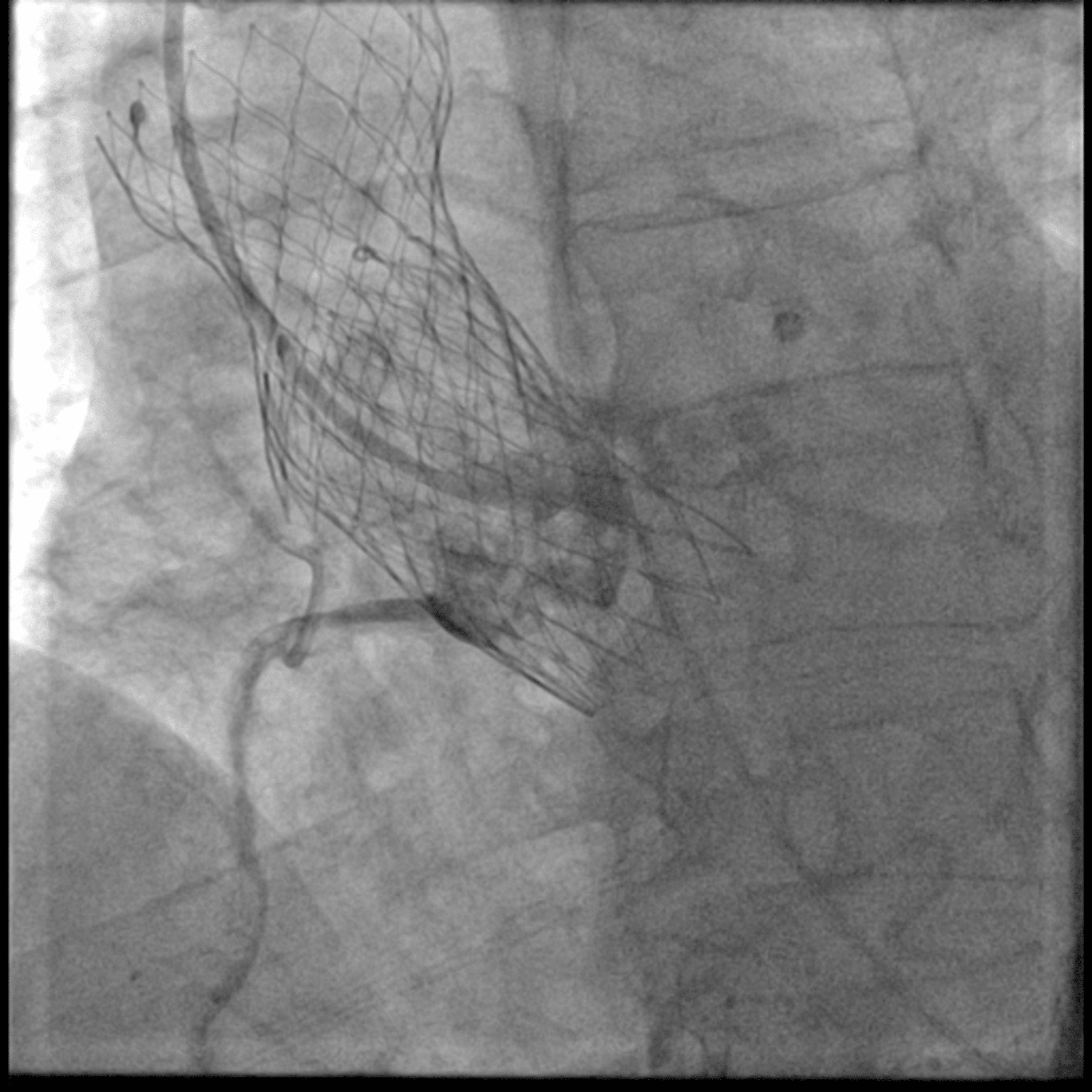 Cureus | A Rare but Deadly Complication of Transcatheter Aortic Valve ...