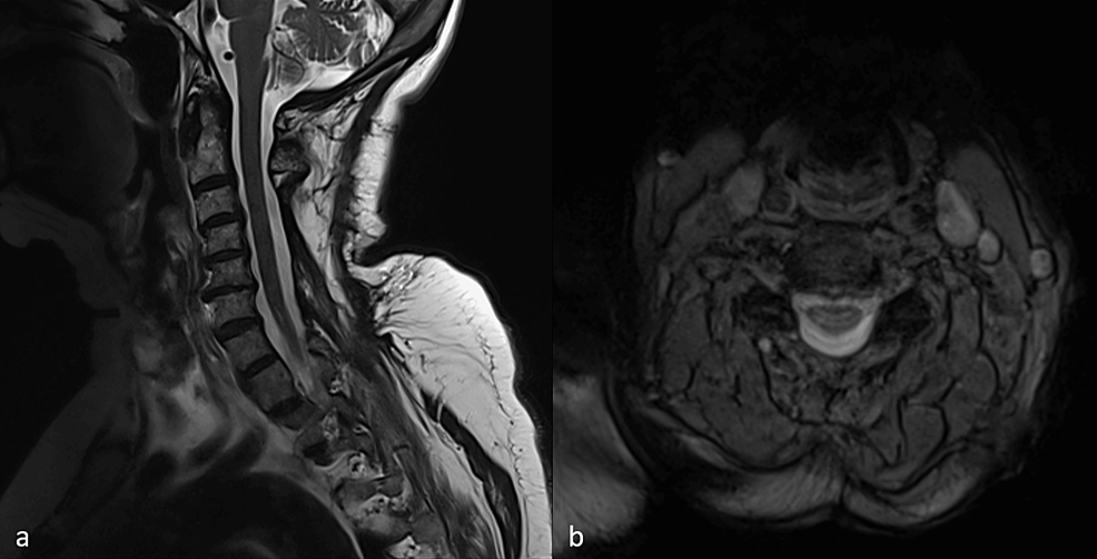 T2-weighted-MRI-of-the-cervical-spine-six-months-postoperatively.