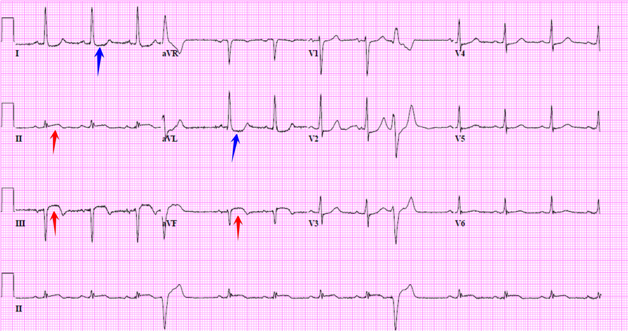 Old Anterior Wall Myocardial Infarction Mi Ecg Learn - Vrogue.co