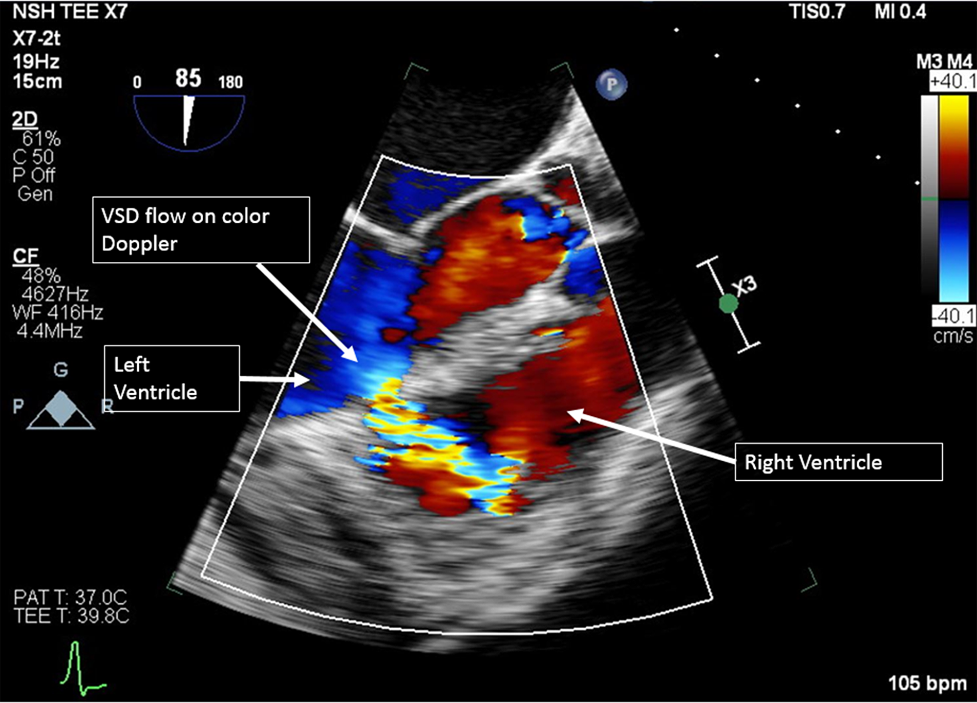 cureus-inferior-wall-st-elevation-myocardial-infarction-complicated