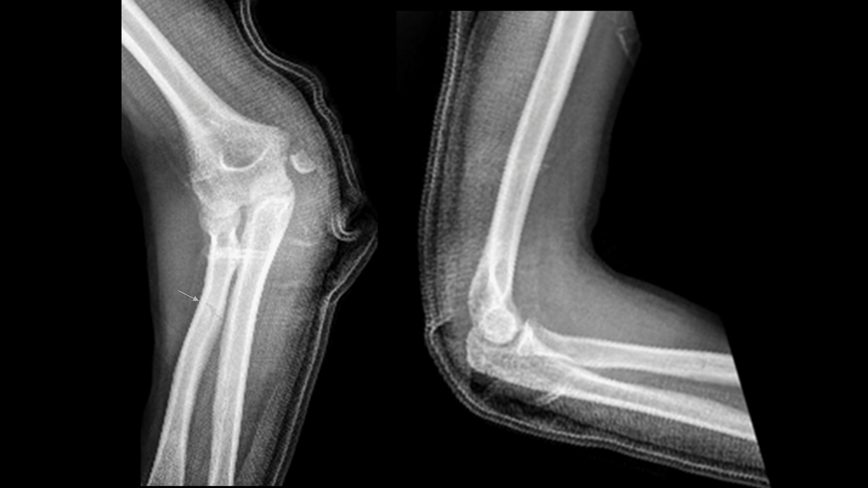 Cureus FloatingVariant Medial Elbow Dislocation A New