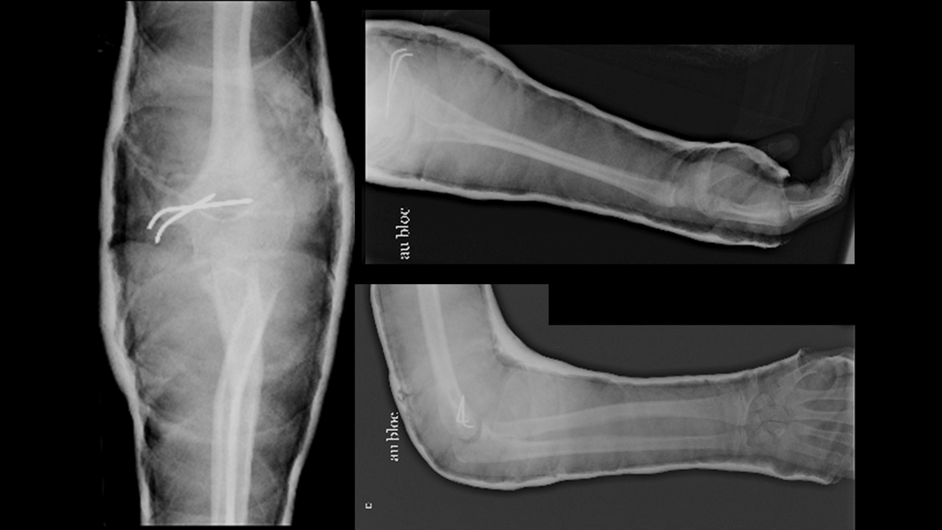 Cureus FloatingVariant Medial Elbow Dislocation A New