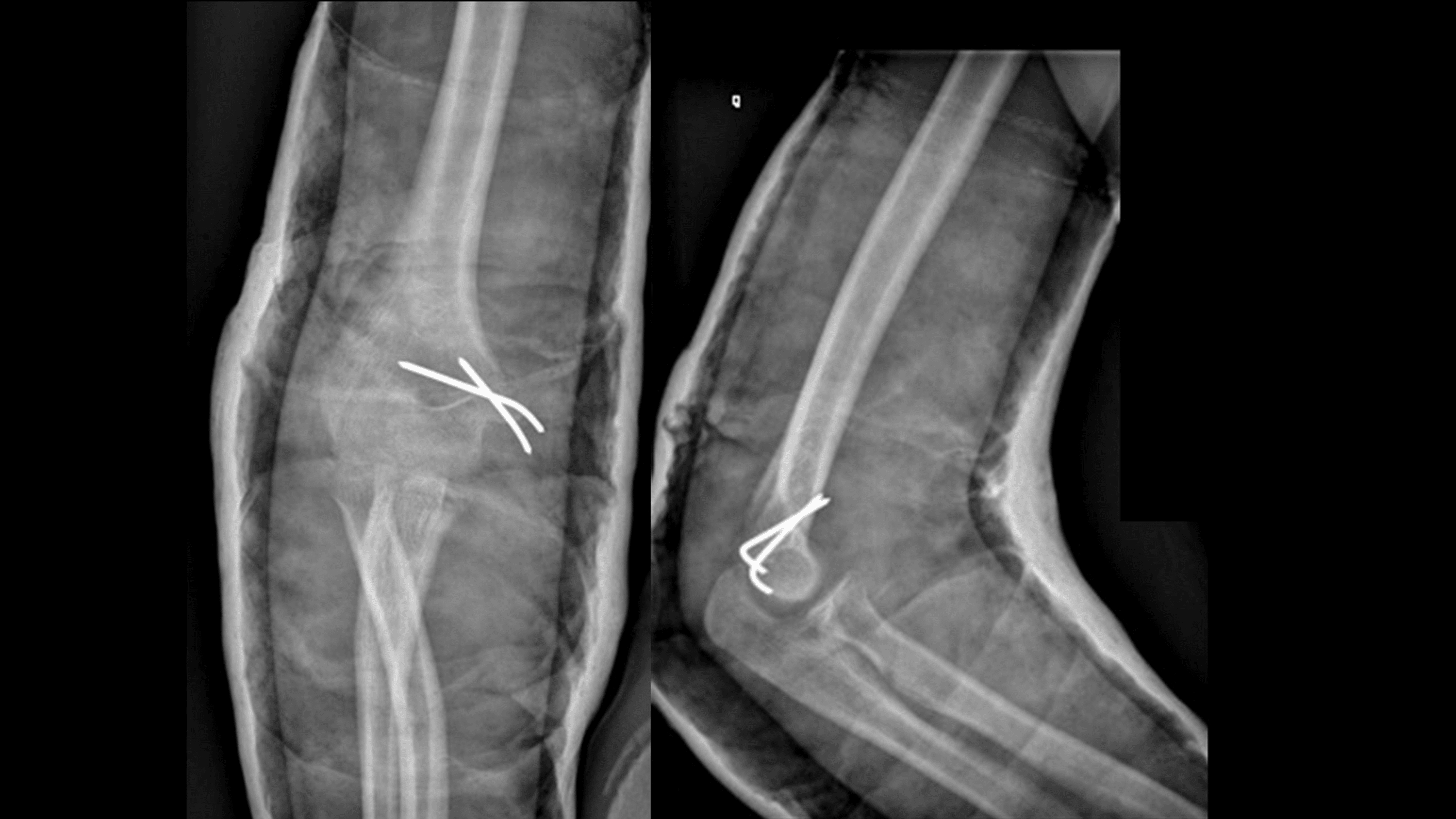 Cureus | Floating-Variant Medial Elbow Dislocation: A New ...