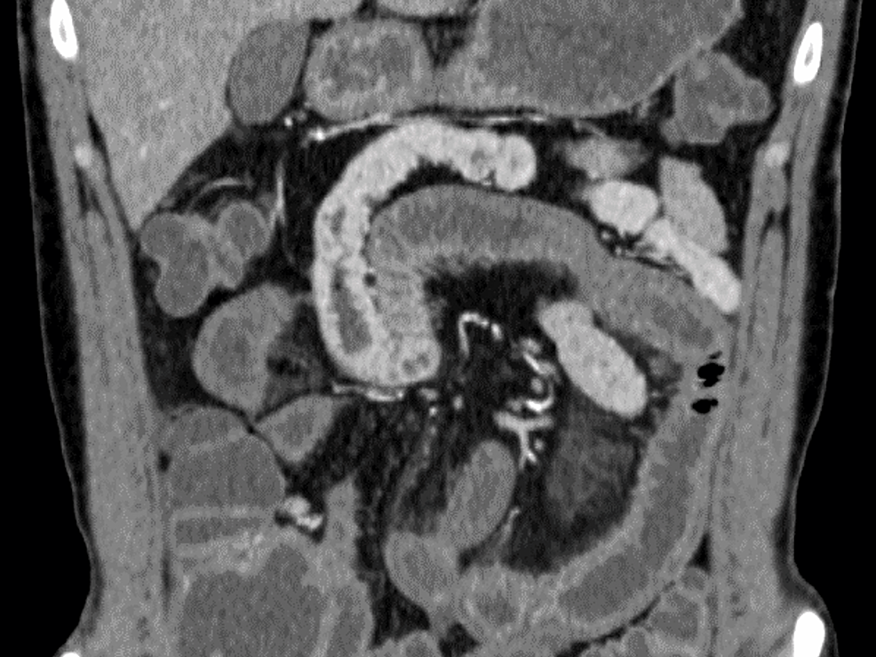 Abdominal-computed-tomography-with-contrast-shows-extensive-edematous-wall-thickening-of-the-small-intestine