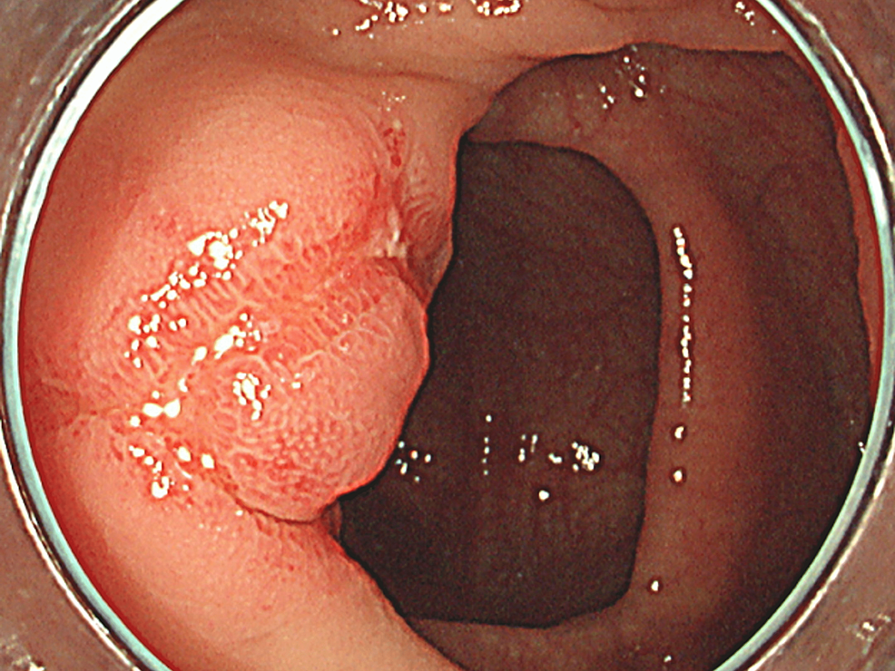 Colonoscopy-shows-a-linear-ulcer-with-a-ring-shaped-structure-at-the-terminal-ileum