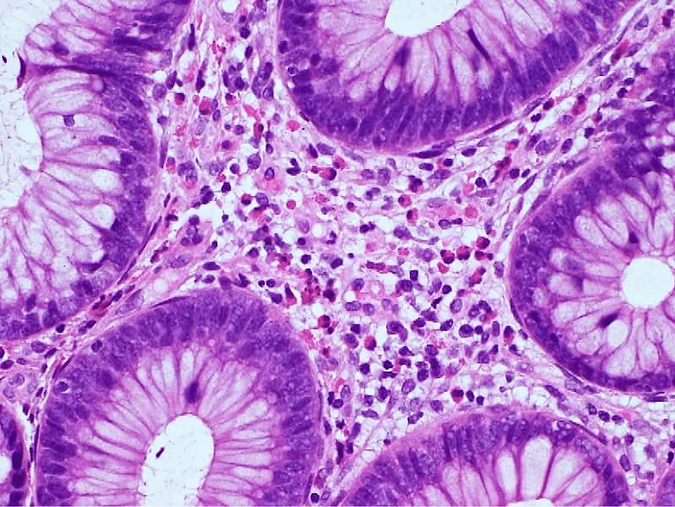 Pathological-finding-of-the-biopsy-of-the-terminal-ileum-showing-the-invasion-of-a-plethora-of-eosinophils-to-the-wall