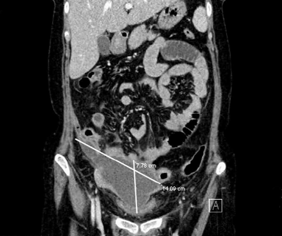 Cureus Bilateral Tubo Ovarian Abscess Colonized By Enterococcus In A 