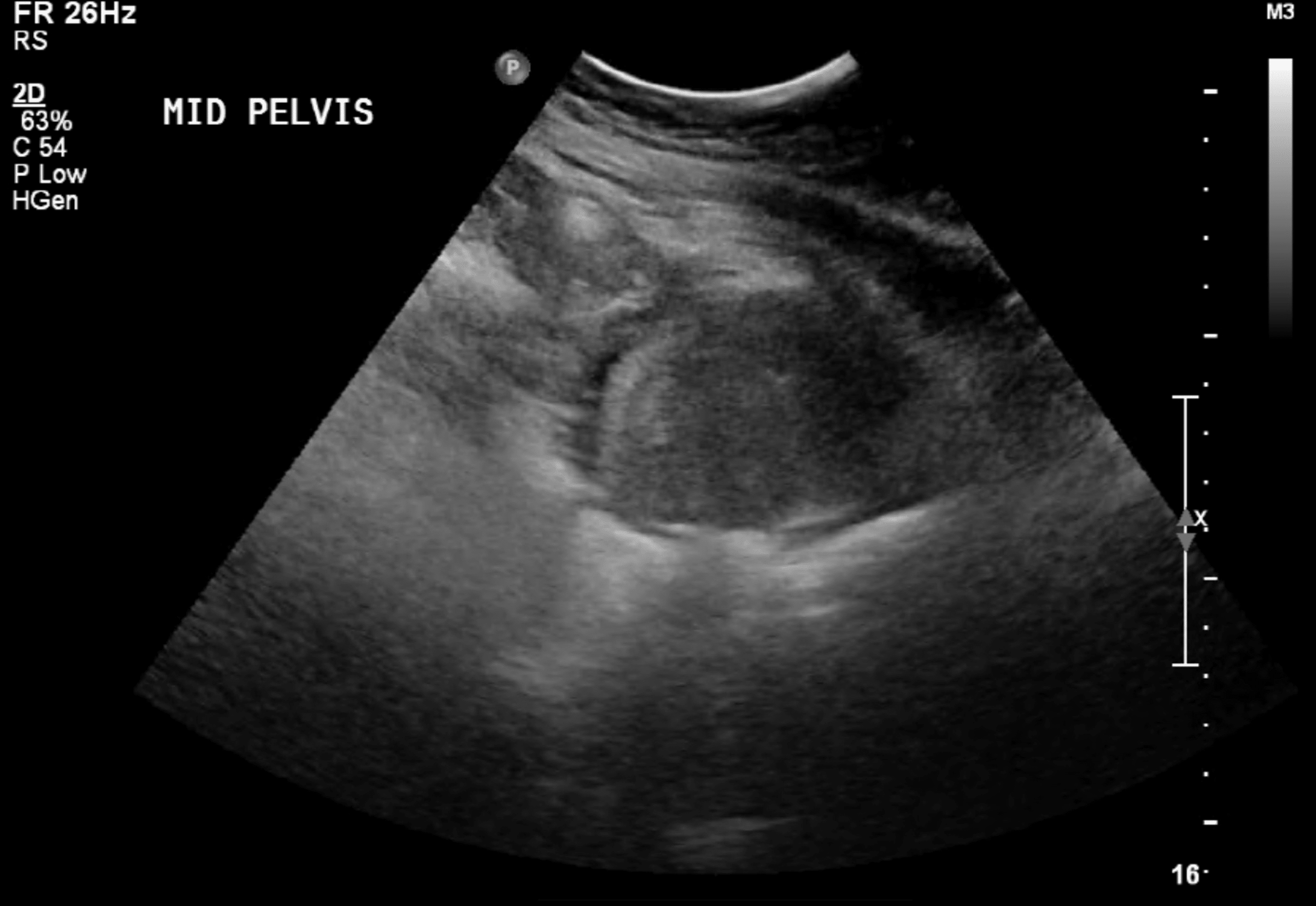 Figure 1 From Sonographic Features Of Tubo Ovarian Ab - vrogue.co