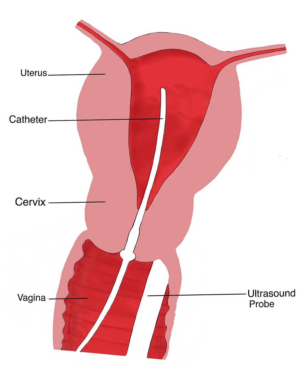 Cureus | Utility of Saline Infusion Sonohysterography in Gynecology: A ...