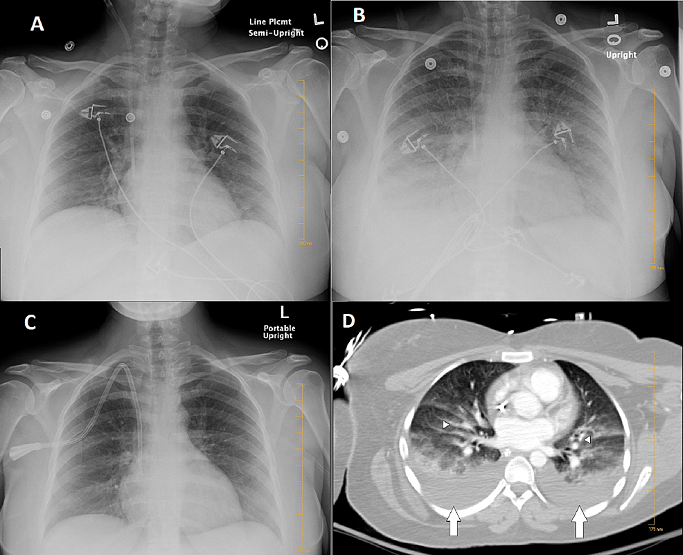 Cureus | Giant Negative T Waves and QT Prolongation in Non-cardiogenic ...