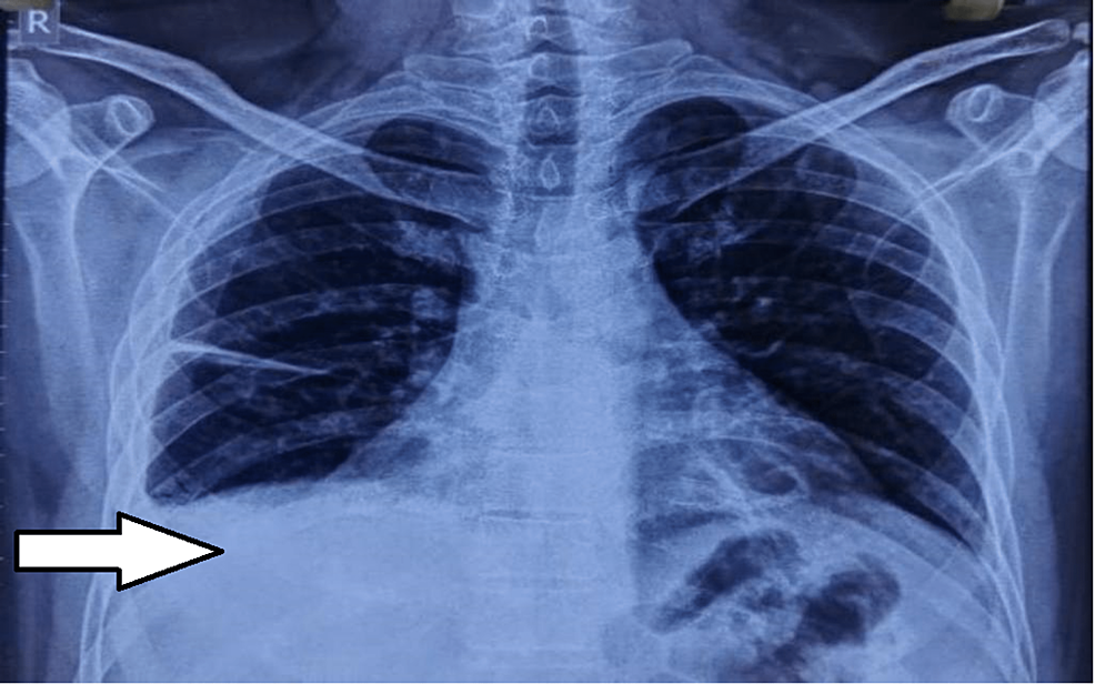 Pulmonary Embolism With Underlying Family History Presenting as Syncope: A Case Report