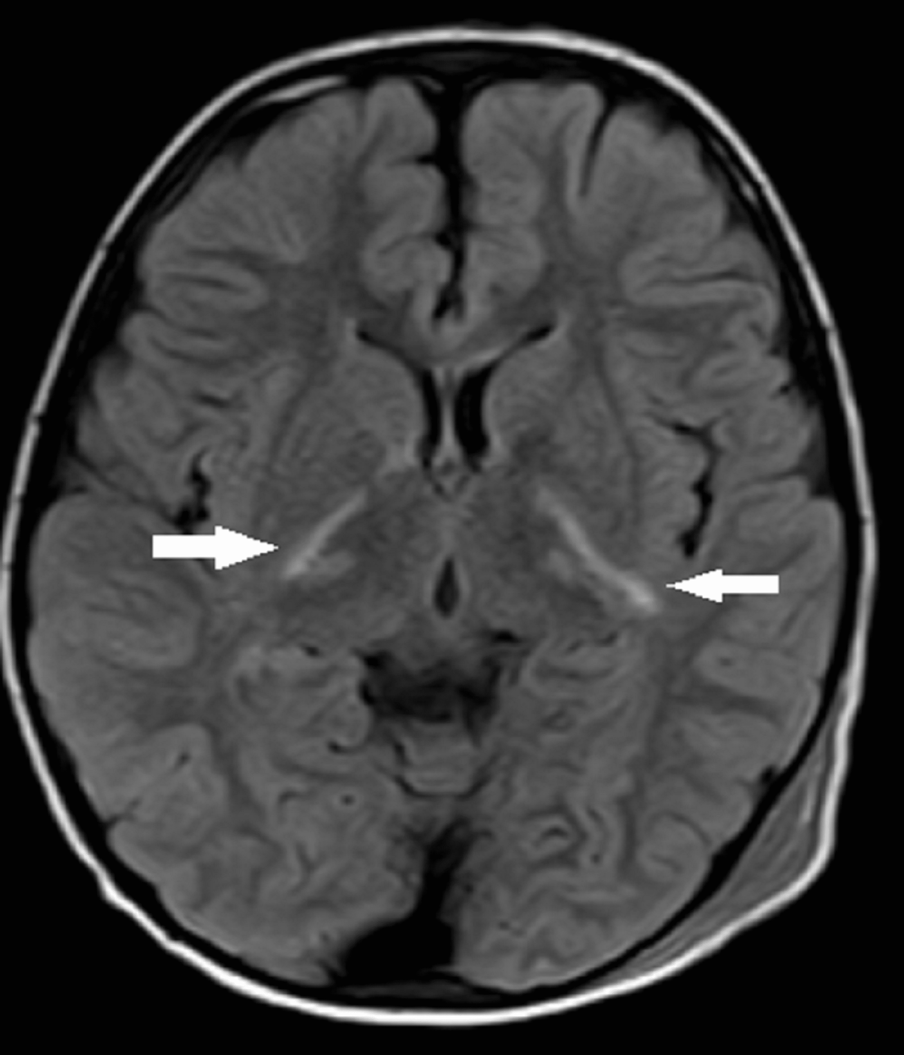 Cureus | Corpus Callosum Infarct in the Background of Varicella-Zoster ...