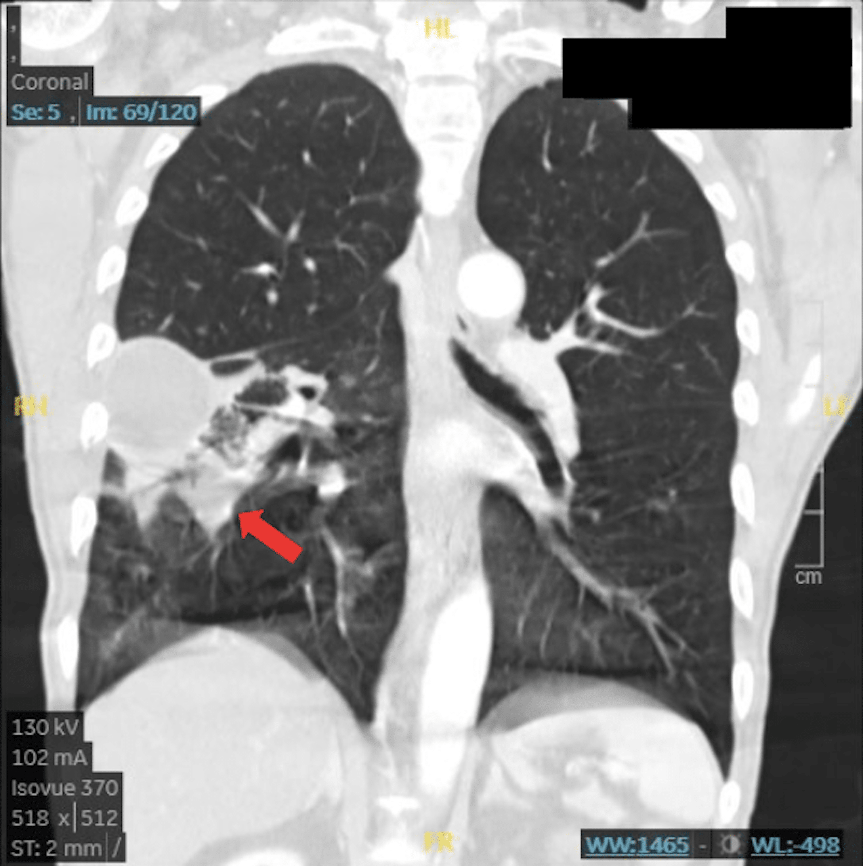 Cureus | Conservative Approach and Management of Complicated Lung Abscess