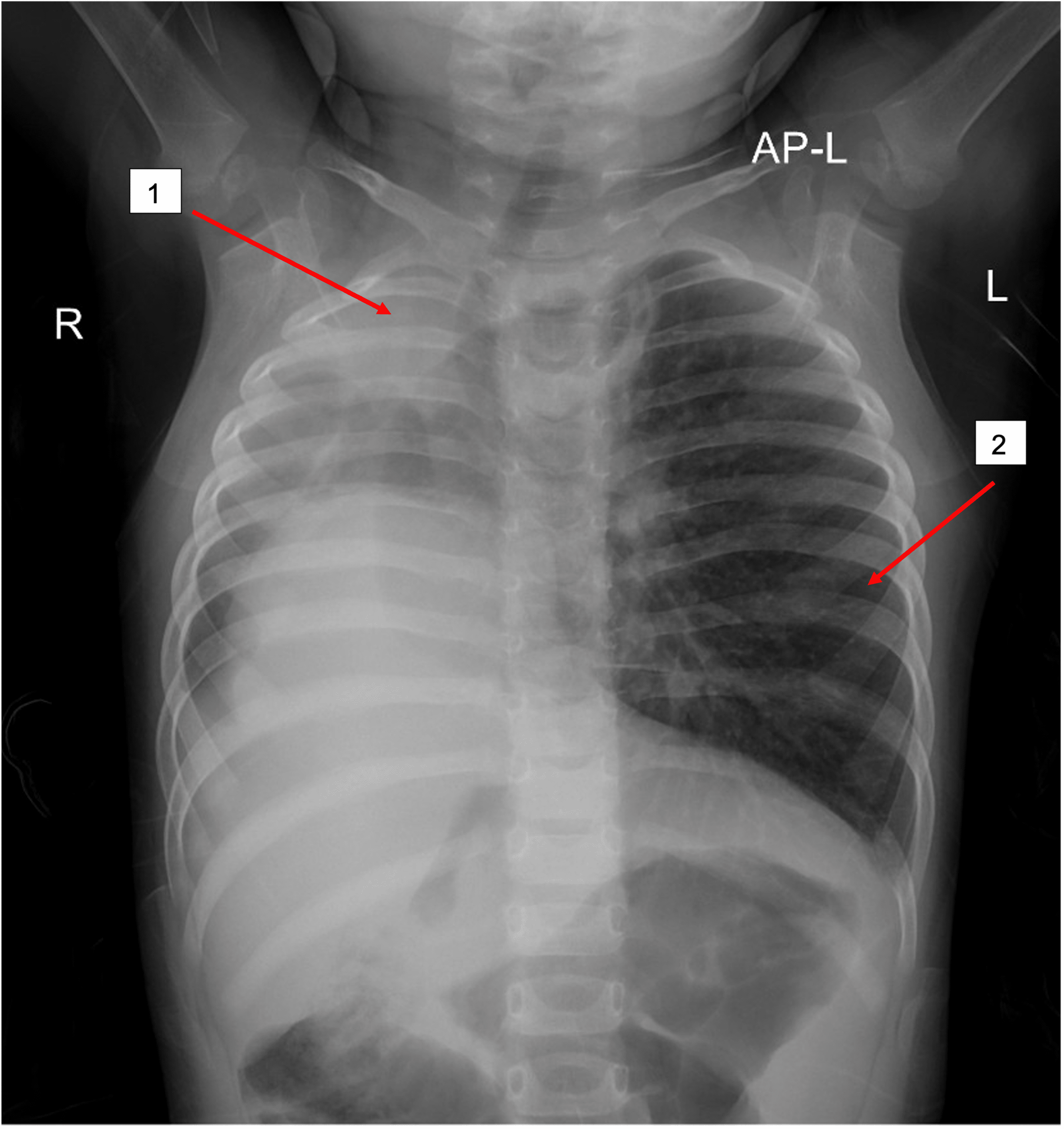 Cureus A Rare Case Of Lung Hypoplasia In A 1 Year Old Girl