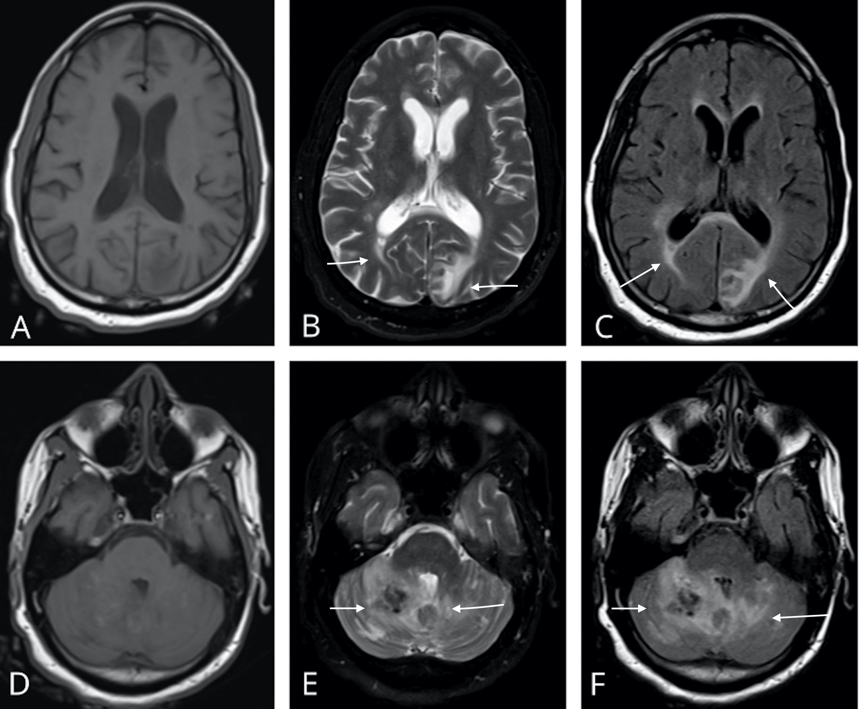 Cureus | Posterior Reversible Encephalopathy Syndrome With Hemorrhagic ...