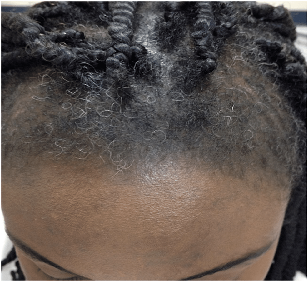 Traction-alopecia