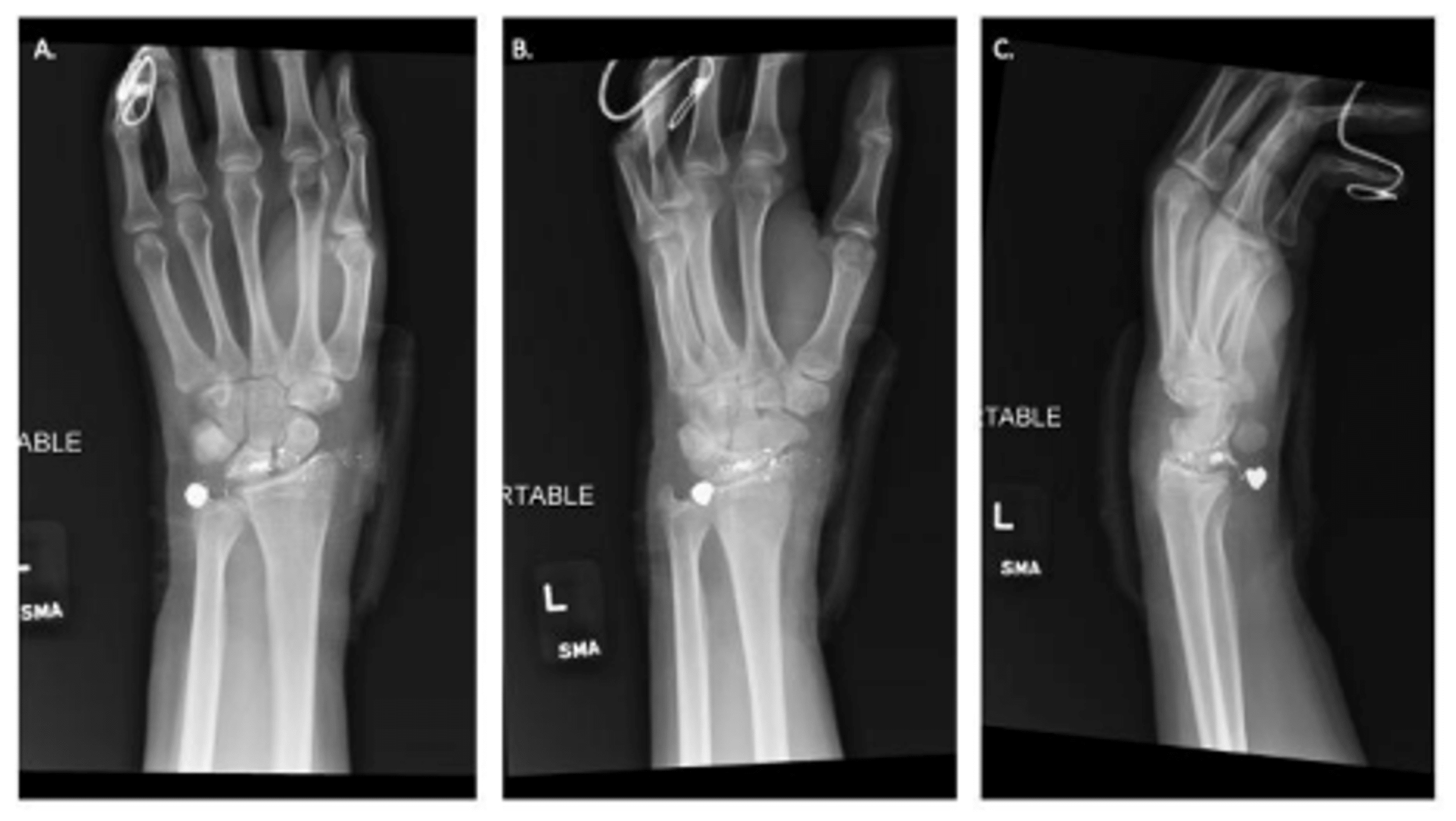 Outpatient Treatment Guidelines of Gunshot Wound to the Hand and Wrist