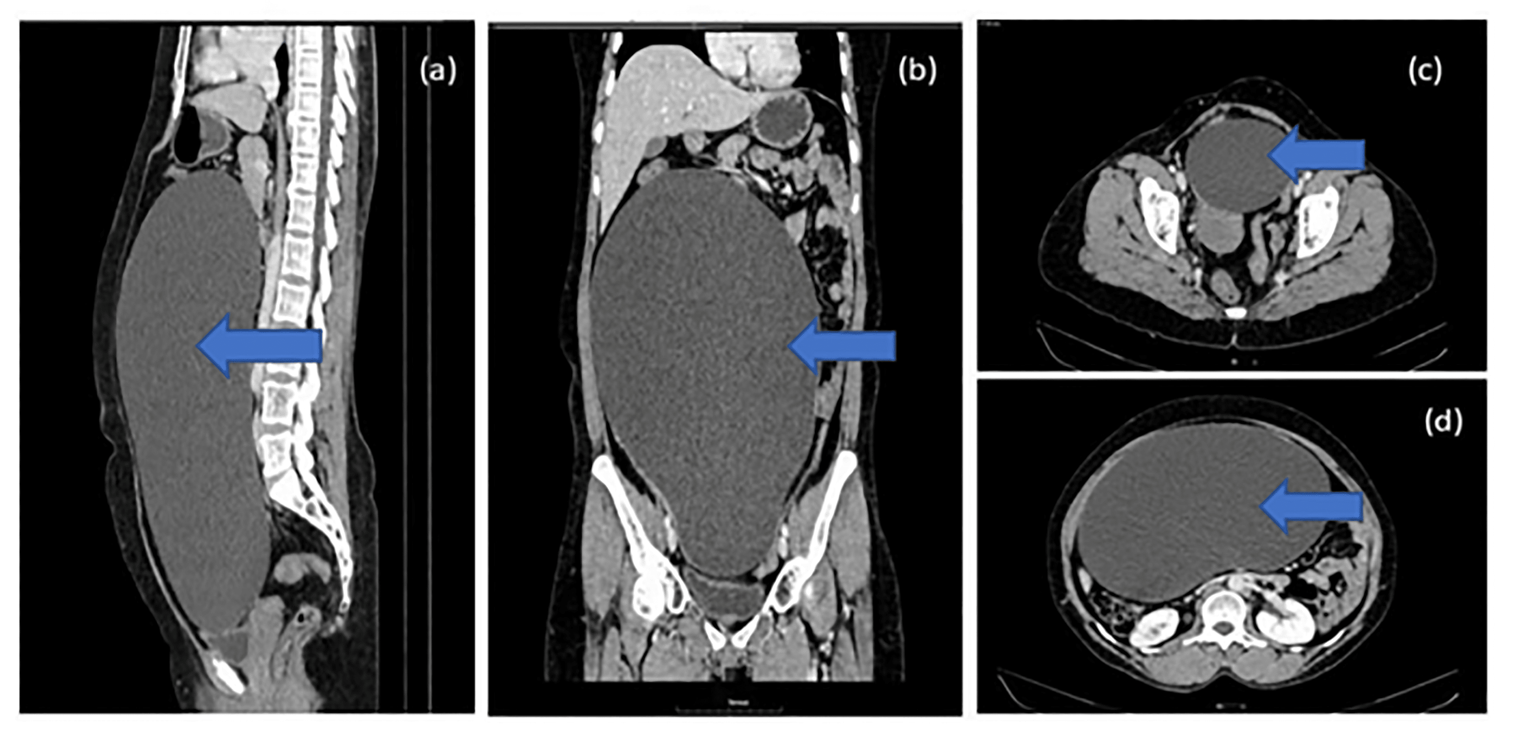 Cureus Endometrial Cyst Presenting as a Vague Abdominal Lump in a