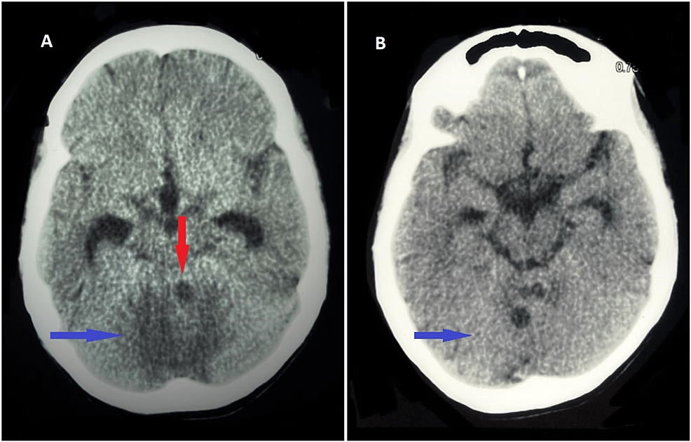 Cureus | Disseminated Tuberculosis Presenting as Cerebellar Dysfunction ...