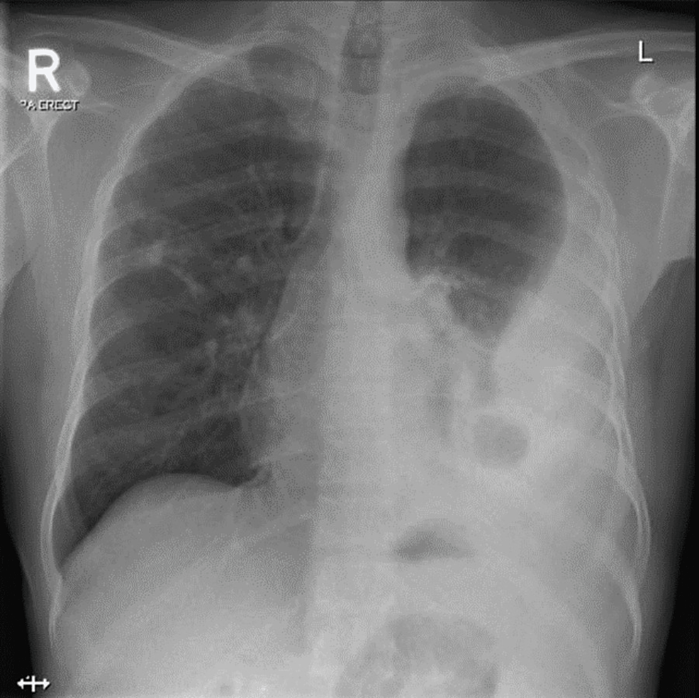 Chest-X-ray-showing-large-left-sided-pleural-effusion-with-collapse-consolidation-of-the-left-lung-lower-lobe.-A-patchy-nodular-opacity-is-seen-in-the-right-lung-mid-zone