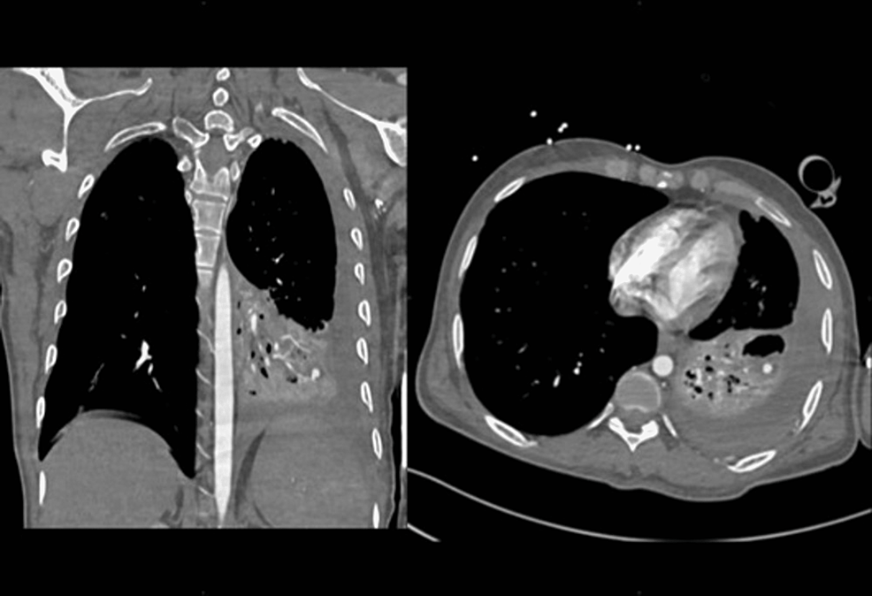 The-CT-pulmonary-angiogram-showing-left-lower-lobe-near-complete-collapse-consolidation-with-at-least-two-cavitary-lesions.-Small-pseudoaneurysm-is-noted-measuring-5-x-6.6-x-5-mm-arising-from-a-subsegmental-branch-of-the-left-lateral-basal-segmental-artery-of-the-left-lower-lobe-adjacent-to-the-cavitary-lesion-(Rasmussen-aneurysm)-in-the-background-of-pulmonary-tuberculosis.
