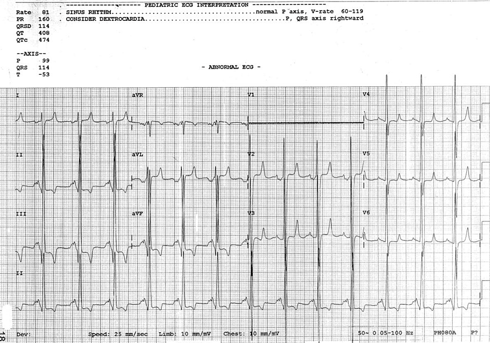 cureus-single-ventricle-with-hypoplastic-left-heart-syndrome-in-a-22