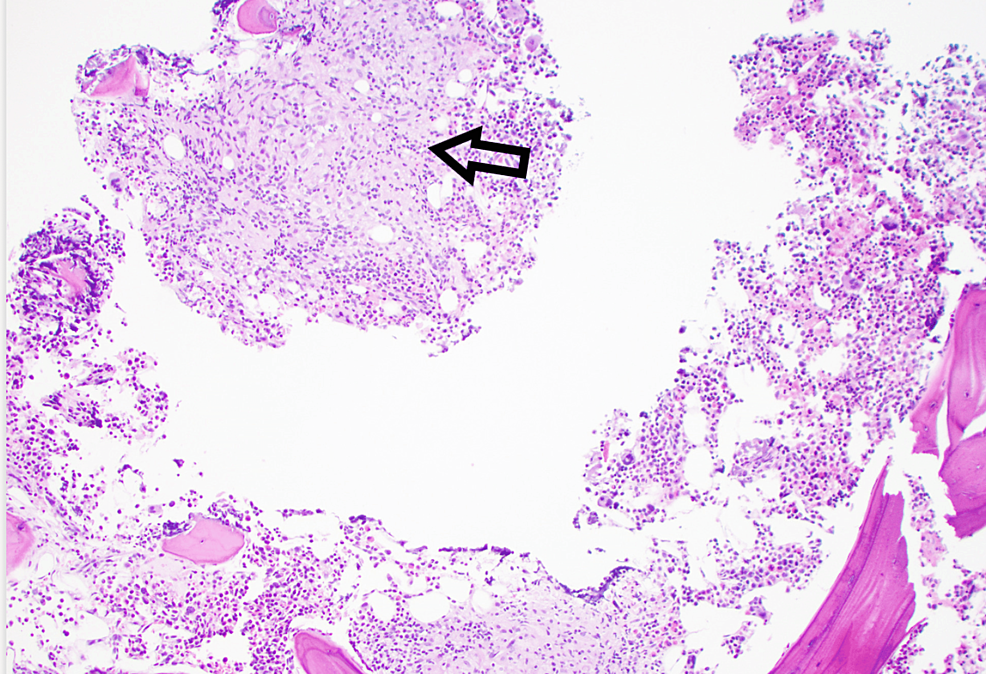 H&amp;E-stained-bone-marrow-biopsy-with-non-caseating-epithelioid-granulomas