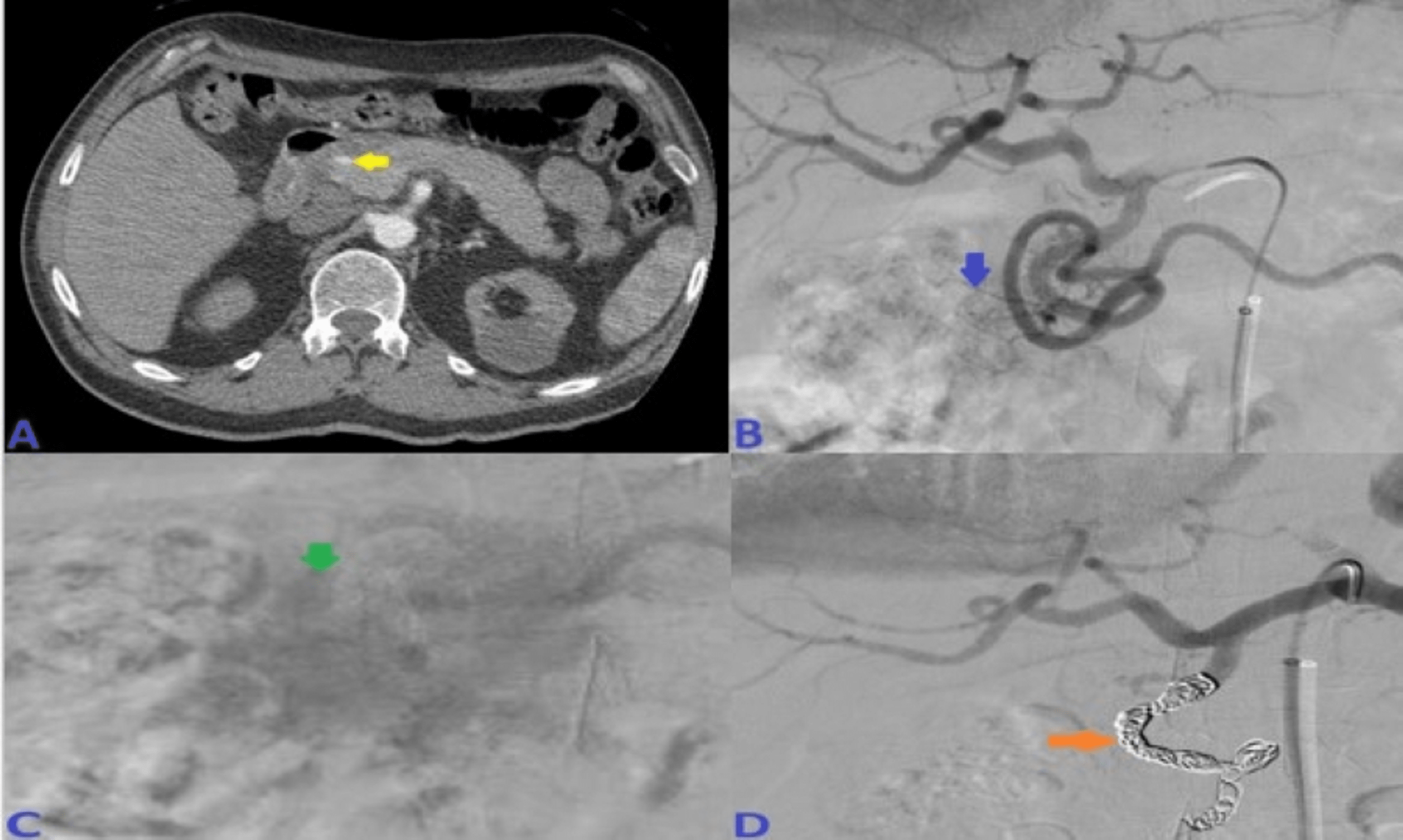 Cureus Role of Transcatheter Arterial Embolization in Acute
