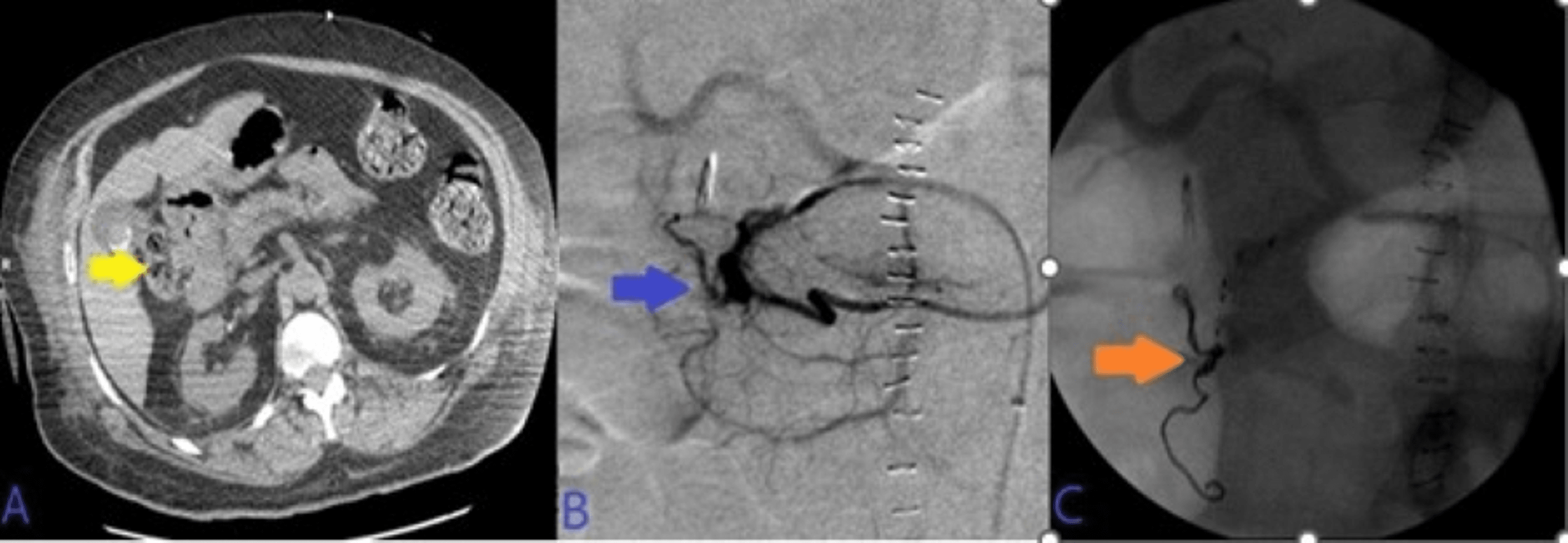 Role of Transcatheter Arterial Embolization in Acute Refractory Non