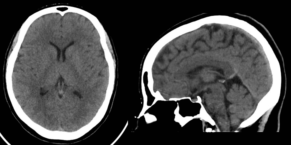 Axial-non-contrast-CT-of-the-brain-at-the-level-of-the-basal-ganglia-and-midline-sagittal-CT-image-showing-normal-finding