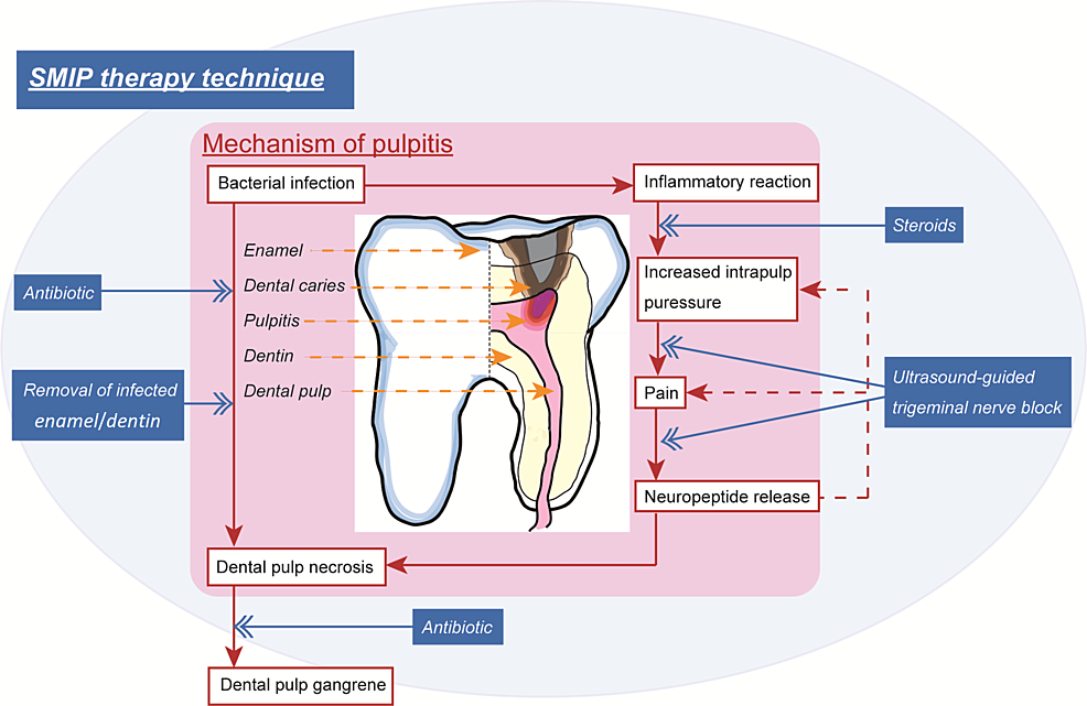Illustration-of-the-mechanisms-mediating-pulpitis-and-the-proposed-super-minimally-invasive-pulp-(SMIP)-therapy-technique.