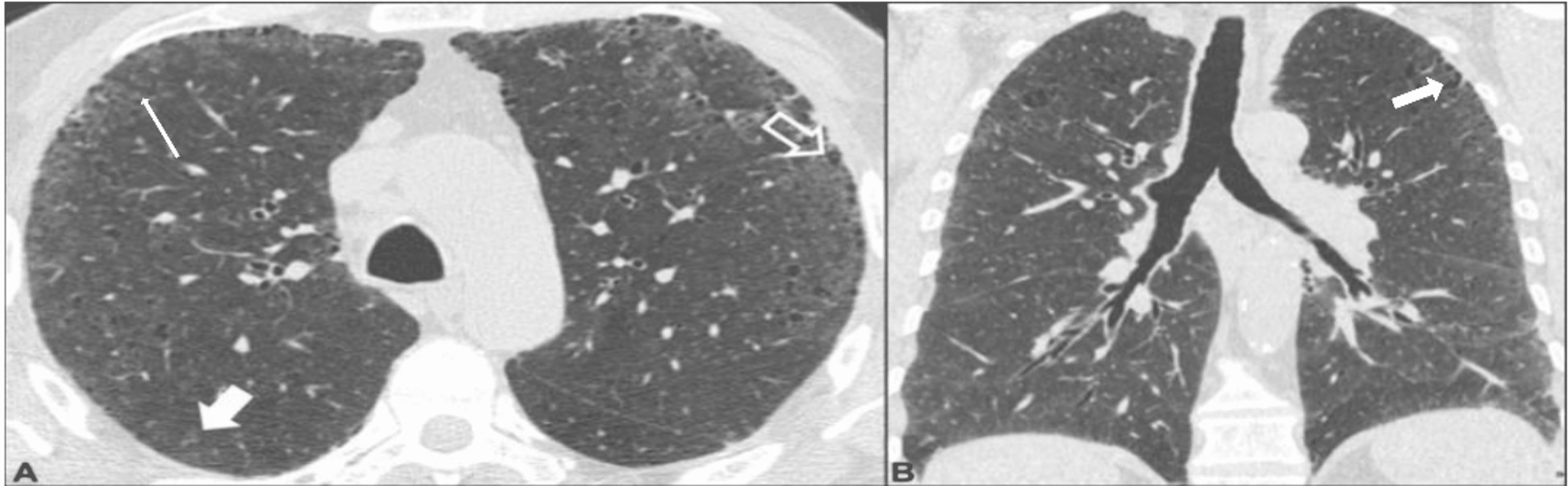 Cureus Role of HighResolution CT Thorax in Diagnosing Interstitial