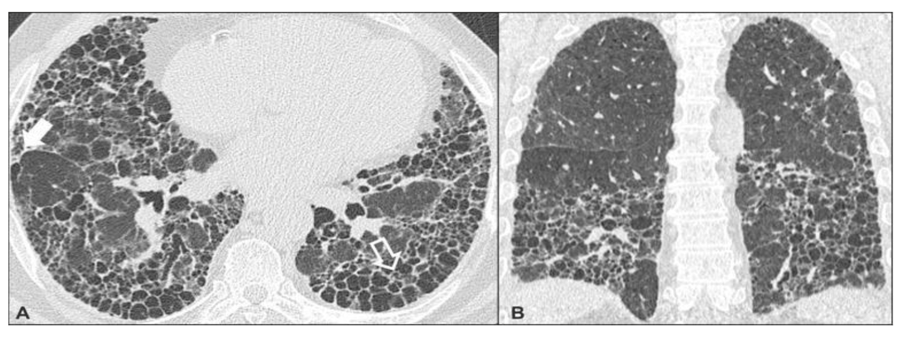 Role Of High Resolution Ct Thorax In Diagnosing Interstitial Lung Disease And Its Association 8167