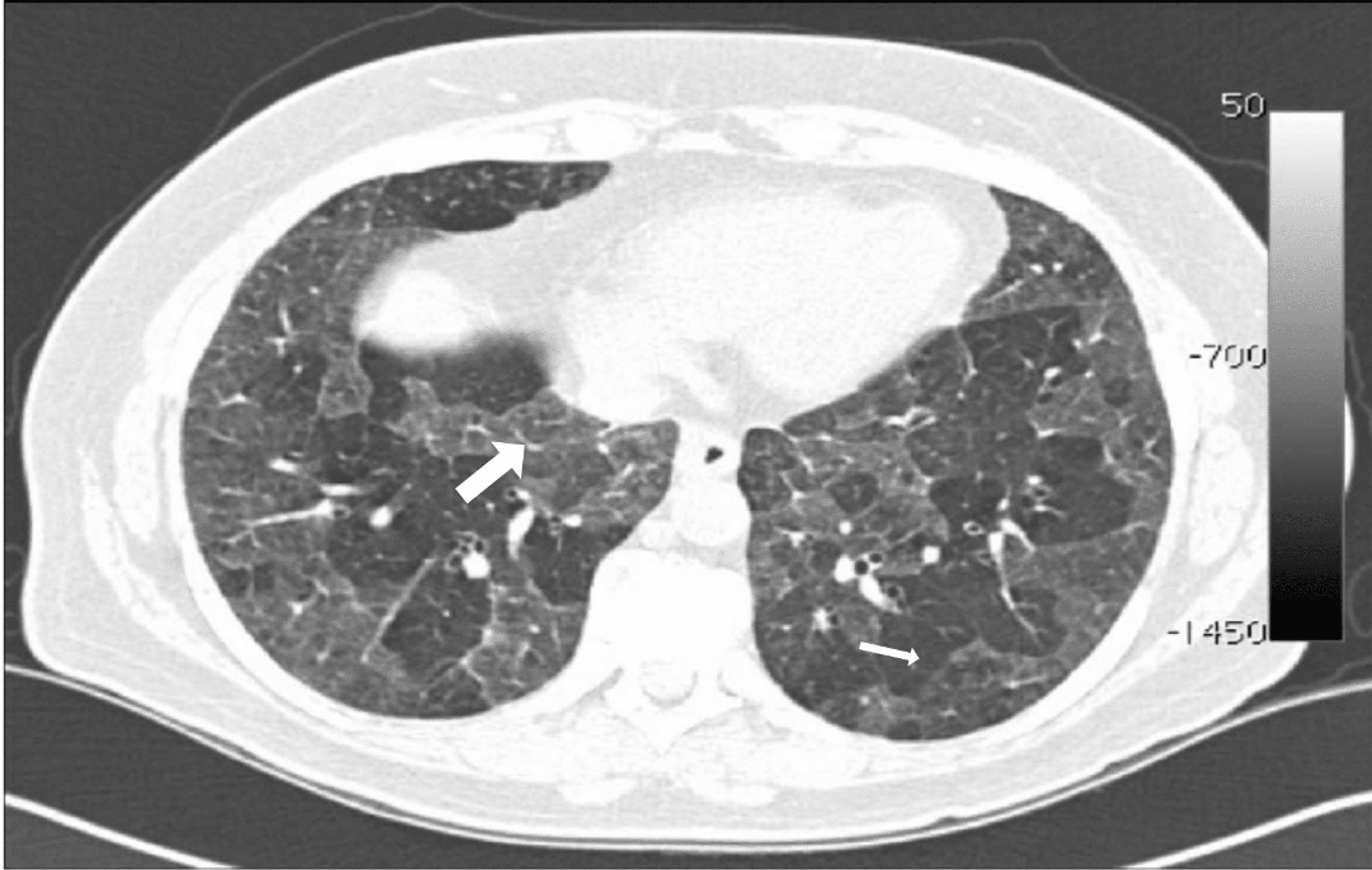 Cureus Role of HighResolution CT Thorax in Diagnosing Interstitial