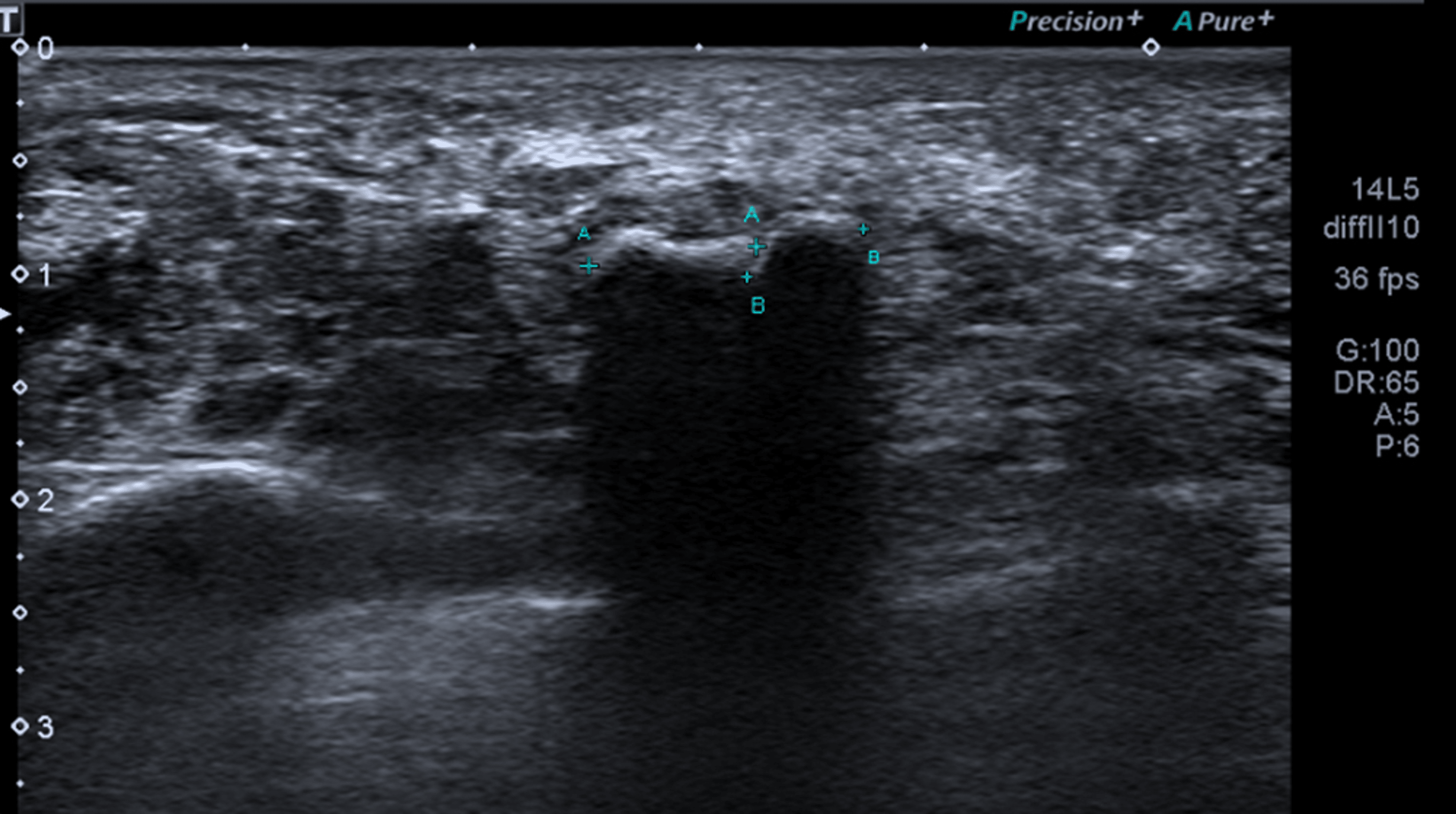 Cureus | Heavily Ossified Soft Tissue Chondroma of Plantar Foot and the ...