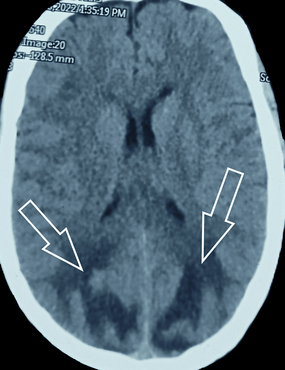 Cureus Posterior Reversible Encephalopathy Syndrome (PRES), 44% OFF