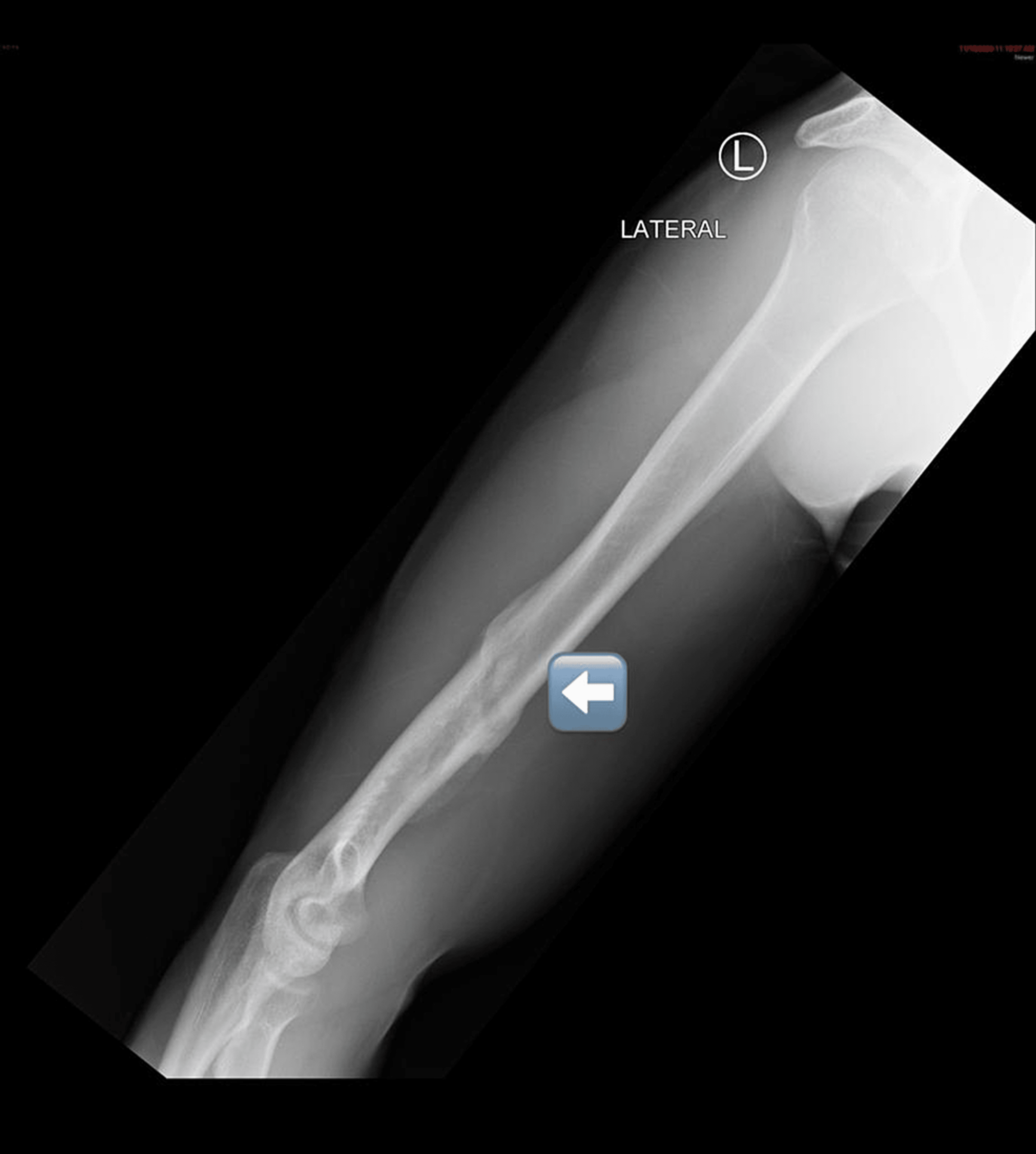 Cureus Spiral Humeral Fracture During Arm Wrestling A Case Report