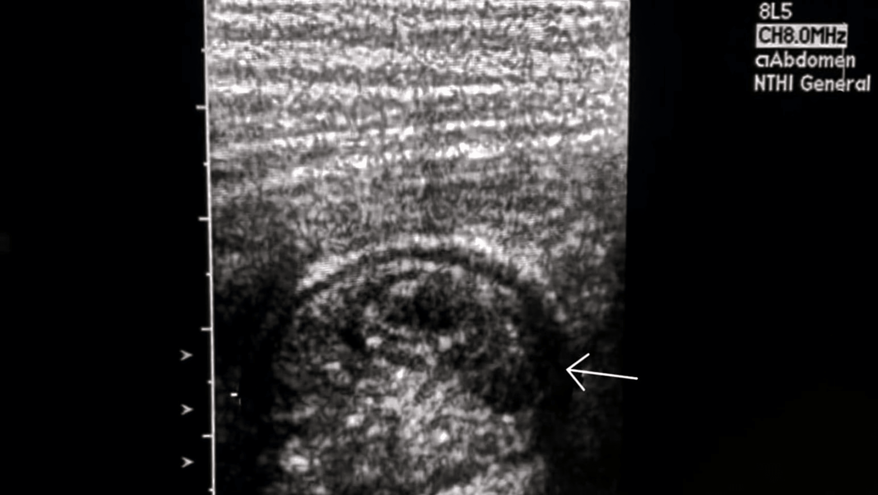 Cureus | Transient Colonic Intussusception Versus Colon Adenocarcinoma ...