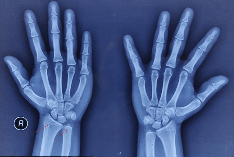 X-ray-of-the-wrist-and-hand.