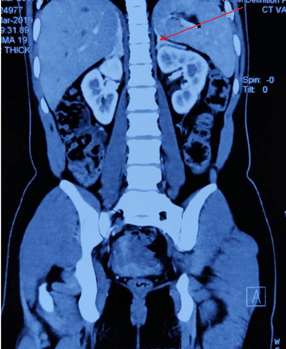 Computerized-tomography-scan-with-contrast-of-the-abdomen-showing-adrenal-hyperplasia-(arrowhead).