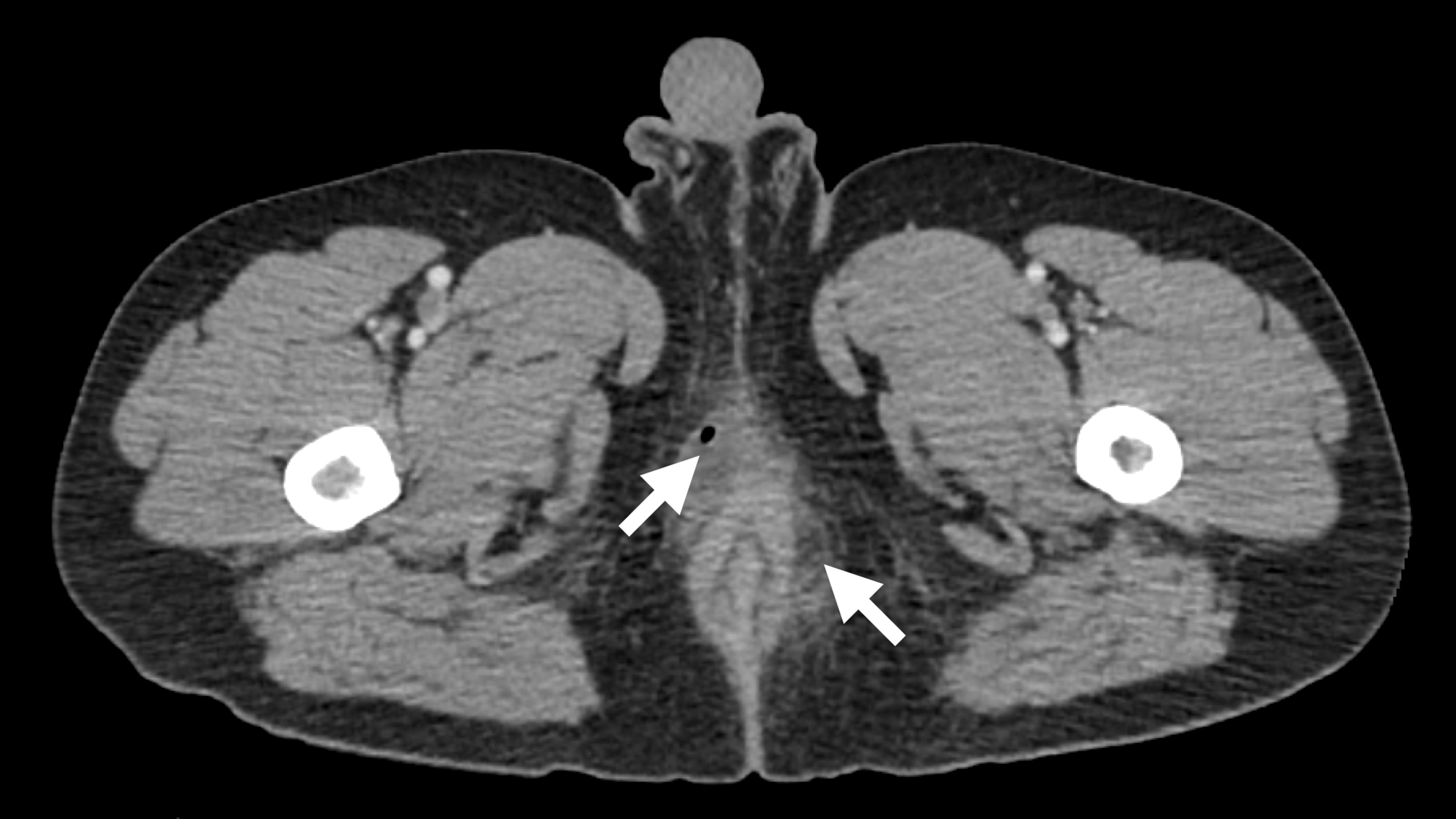Cureus Perianal Abscess Following Excisional Hemorrhoidectomy in an