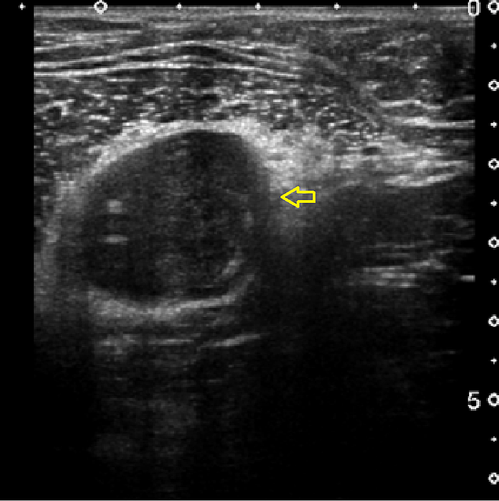 cureus-chest-wall-schwannoma-case-report-and-a-review-of-imaging