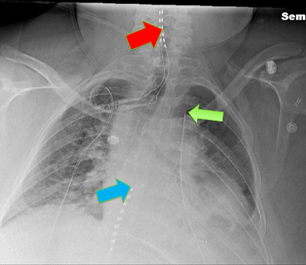 Erector Spinae Plane Catheter for Postoperative Thoracotomy Pain in a