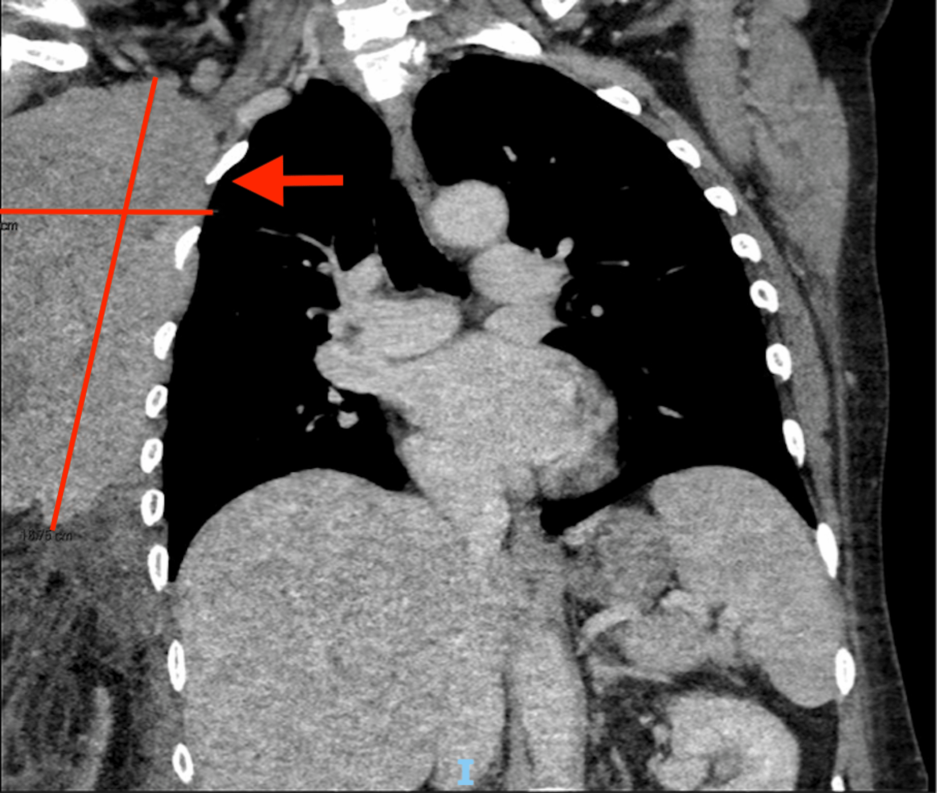 A Rare Case Of Primary Breast Diffuse Large B-cell Lymphoma In An ...