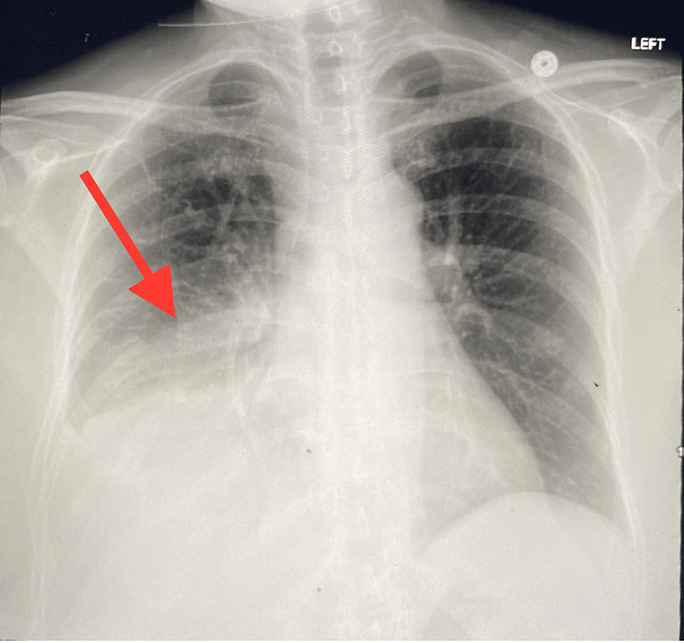 necrotizing pneumonia radiology