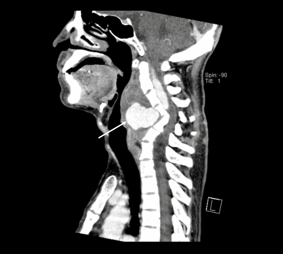CTA-vertebral-artery.