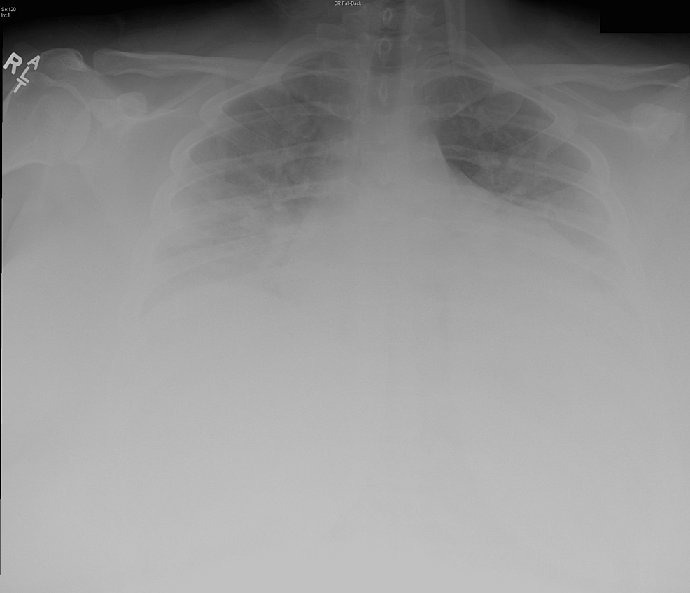 Severe COVID-19 Pneumonia in an Unvaccinated Female Treated With ...