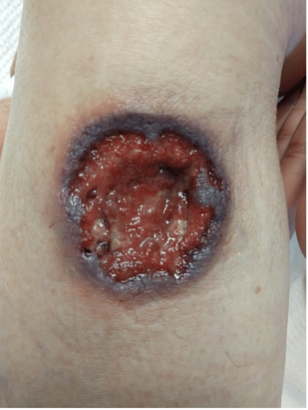 A Rare Form of Granulomatosis With Polyangiitis With Pyoderma ...