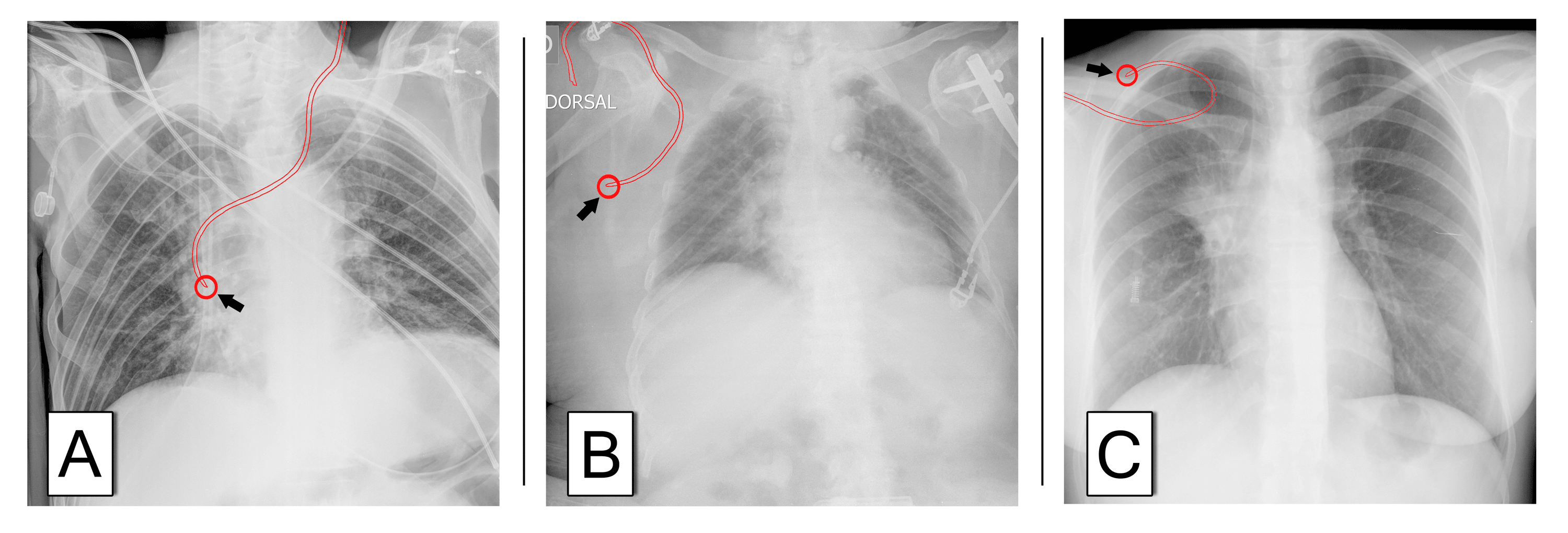 Cureus | “Optimal” Central Venous Catheter Tip Position Does Not ...