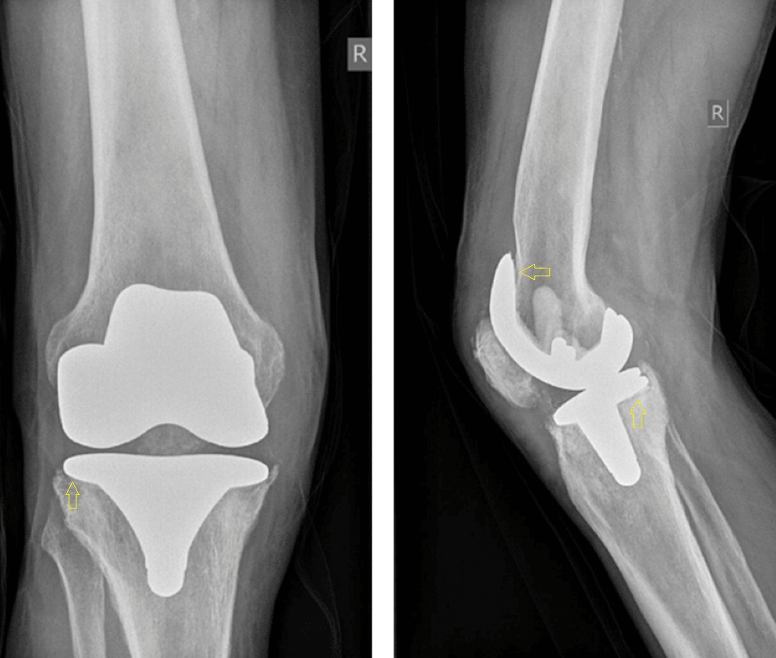 Cureus | Prosthetic Knee Joint Infection by Brucella melitensis